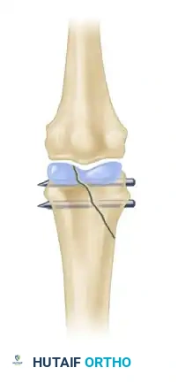 Intraarticular Hand Fractures: Surgical Management & Malunion