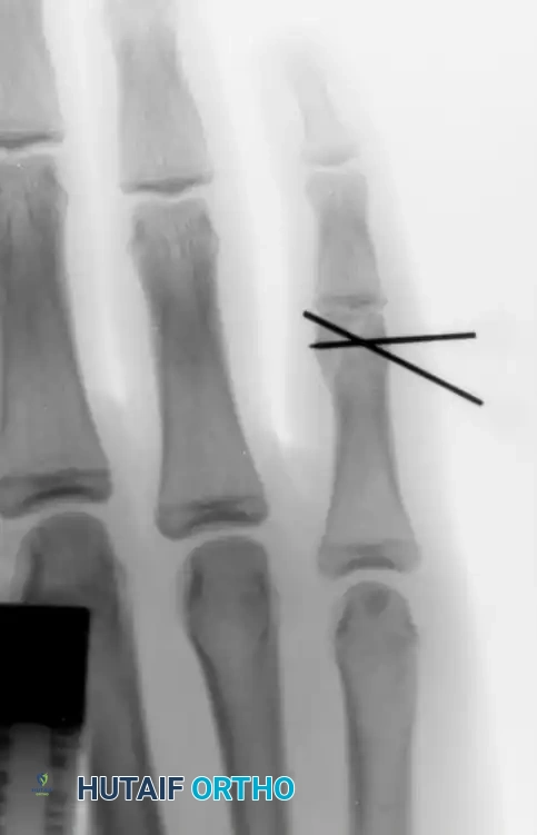 INTRAARTICULAR FRACTURES Surgical Diagram