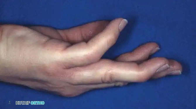 Fig. 64-64 A, Acute type 1 mallet ﬁ nger with secondary “swanning” of proximal interphalangeal joint. B, Aluminum splint achieving full extension of distal interphalangeal joint.