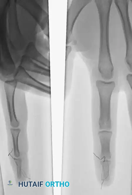 Fig. 64-65 A, Type 4 mallet ﬁ nger in high school basketball player. B, Results of pull-out wire and pin ﬁ xation of distal interphalangeal joint just before pin removal at 4 weeks. C, Pull-out wire left in until 6 weeks after surgery.