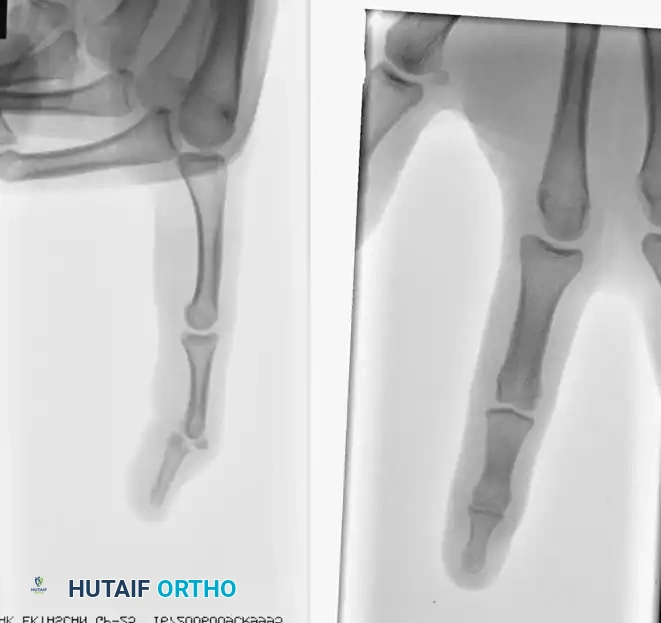 INTRAARTICULAR FRACTURES Surgical Diagram