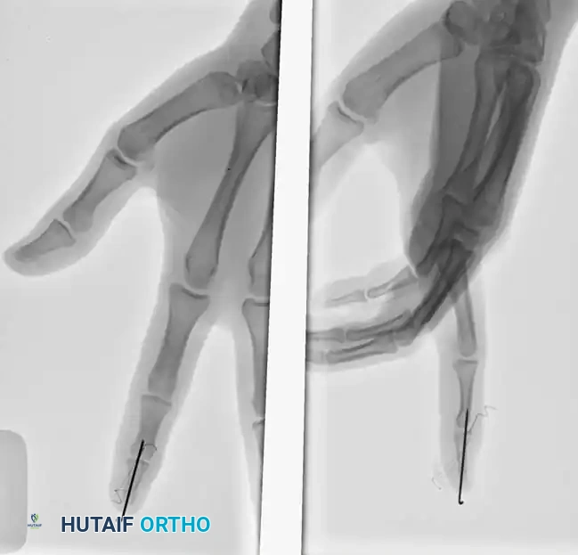 INTRAARTICULAR FRACTURES Surgical Diagram