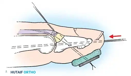 INTRAARTICULAR FRACTURES Surgical Diagram