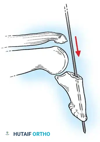 INTRAARTICULAR FRACTURES Surgical Diagram