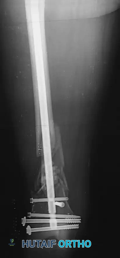 FIGURE 53-36 Dynamic (A) and static (B) locking of intramedul­ lary nail.