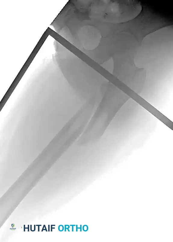 Intramedullary Nailing in Reconstruction Mode: Surgical Guide