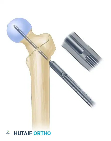 INTRAMEDULLARY NAILING OF INTERTROCHANTERIC FEMORAL FRACTURES Surgical Diagram