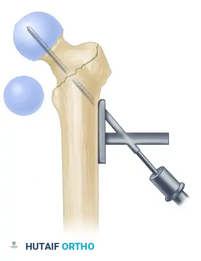 INTRAMEDULLARY NAILING OF INTERTROCHANTERIC FEMORAL FRACTURES Surgical Diagram