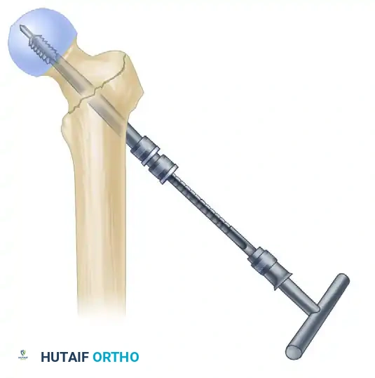 INTRAMEDULLARY NAILING OF INTERTROCHANTERIC FEMORAL FRACTURES Surgical Diagram
