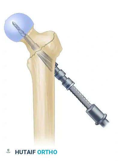 INTRAMEDULLARY NAILING OF INTERTROCHANTERIC FEMORAL FRACTURES Surgical Diagram