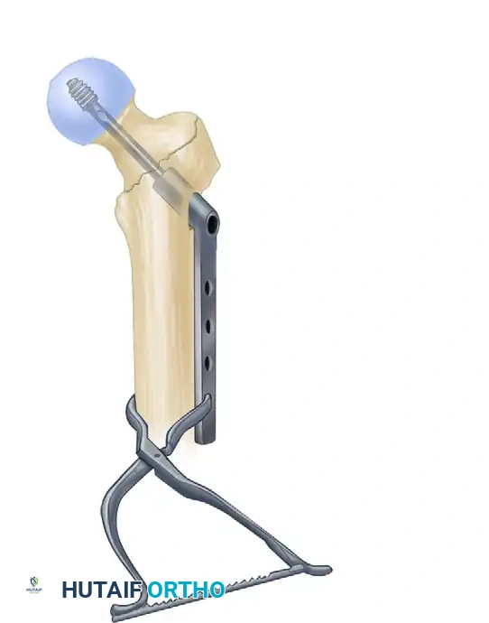 INTRAMEDULLARY NAILING OF INTERTROCHANTERIC FEMORAL FRACTURES Surgical Diagram