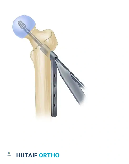 INTRAMEDULLARY NAILING OF INTERTROCHANTERIC FEMORAL FRACTURES Surgical Diagram