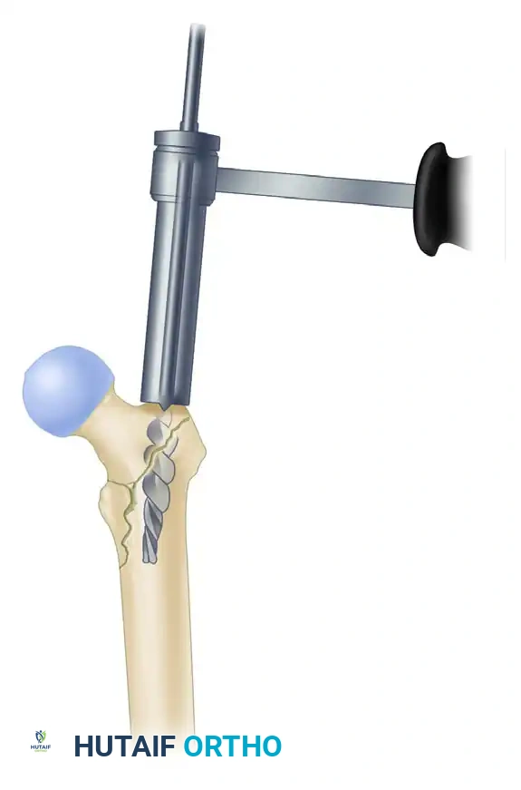 B, Use of entry reamer to ream to level of lesser trochanter.