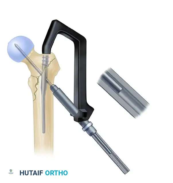 INTRAMEDULLARY NAILING OF INTERTROCHANTERIC FEMORAL FRACTURES Surgical Diagram