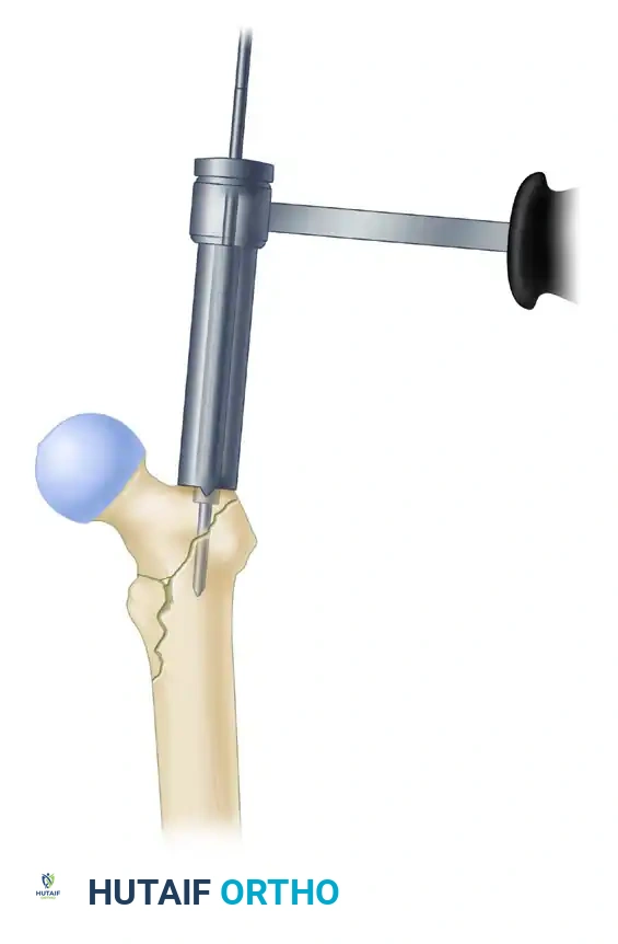 Fixation of intertrochanteric fracture with intramedullary hip screw. A, Localization of guide pin.