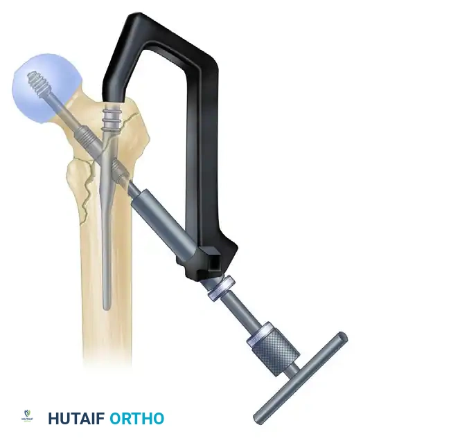 F, Reaming for placement of lag screw.