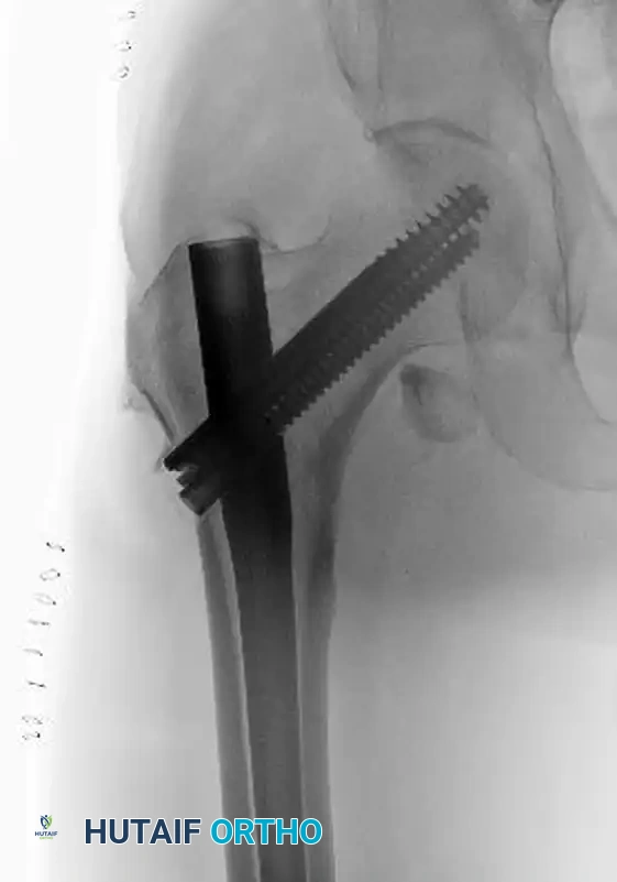 INTRAMEDULLARY NAILING OF INTERTROCHANTERIC FEMORAL FRACTURES WITH INTEGRATED PROXIMAL INTERLOCKING SCREWS (INTERTAN) Surgical Diagram