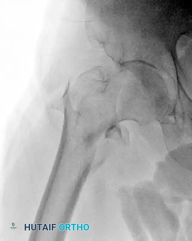INTRAMEDULLARY NAILING OF INTERTROCHANTERIC FEMORAL FRACTURES WITH INTEGRATED PROXIMAL INTERLOCKING SCREWS (INTERTAN) Surgical Diagram