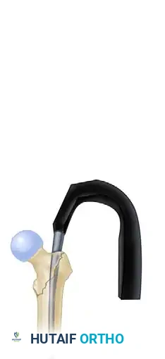 INTRAMEDULLARY NAILING OF INTERTROCHANTERIC FEMORAL FRACTURES WITH INTEGRATED PROXIMAL INTERLOCKING SCREWS (INTERTAN) Surgical Diagram