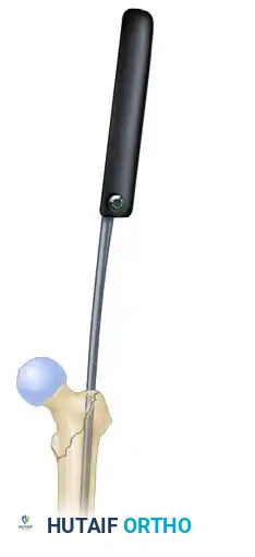 INTRAMEDULLARY NAILING OF INTERTROCHANTERIC FEMORAL FRACTURES WITH INTEGRATED PROXIMAL INTERLOCKING SCREWS (INTERTAN) Surgical Diagram