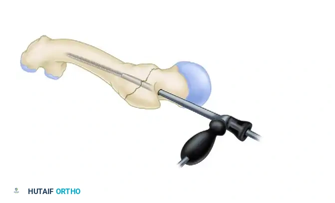 INTRAMEDULLARY NAILING OF INTERTROCHANTERIC FEMORAL FRACTURES WITH INTEGRATED PROXIMAL INTERLOCKING SCREWS (INTERTAN) Surgical Diagram