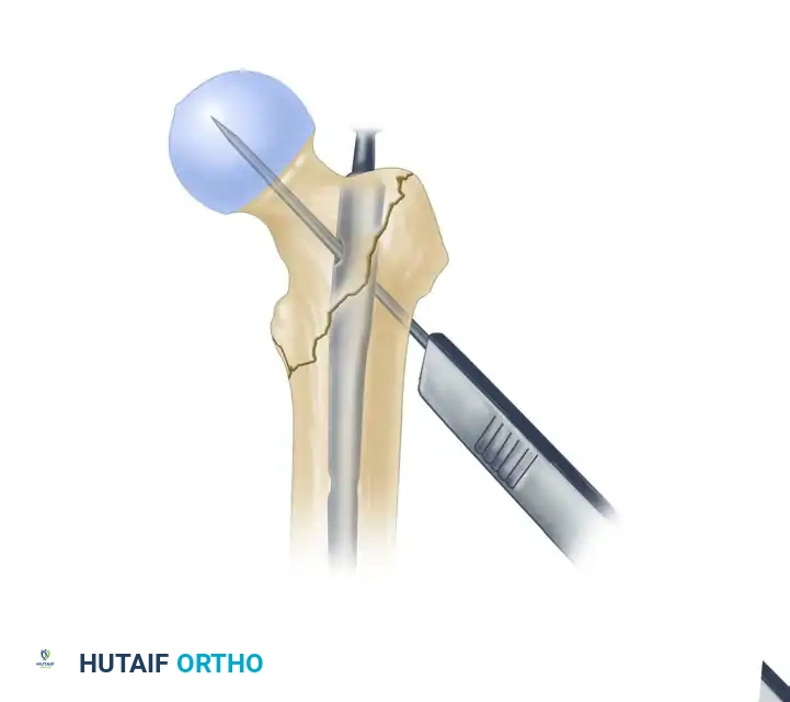 INTRAMEDULLARY NAILING OF INTERTROCHANTERIC FEMORAL FRACTURES WITH INTEGRATED PROXIMAL INTERLOCKING SCREWS (INTERTAN) Surgical Diagram