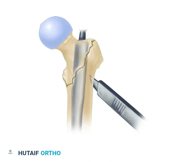 INTRAMEDULLARY NAILING OF INTERTROCHANTERIC FEMORAL FRACTURES WITH INTEGRATED PROXIMAL INTERLOCKING SCREWS (INTERTAN) Surgical Diagram