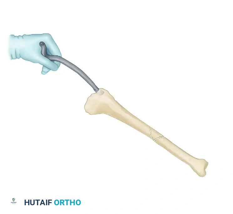 Intramedullary Nailing of Tibial Shaft Fractures: A Comprehensive Surgical Guide