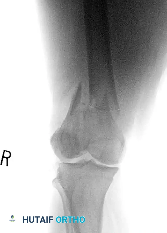 INTRAMEDULLARY NAILING Surgical Diagram