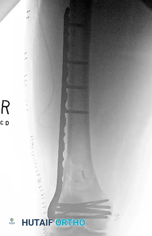 INTRAMEDULLARY NAILING Surgical Diagram