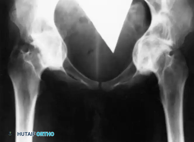 Fig. 25-38 Intrapelvic protrusio acetabuli. Severe bilateral progressive protrusion of acetabulum with severe pain and decreased motion in both hips.
