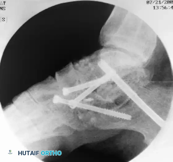 ISOLATED MEDIAL INCISION FOR TRIPLE ARTHRODESIS Surgical Diagram