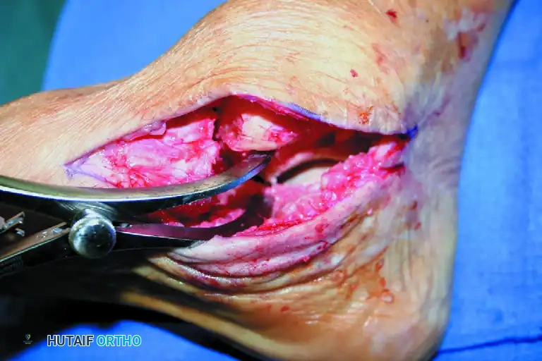 ISOLATED MEDIAL INCISION FOR TRIPLE ARTHRODESIS Surgical Diagram