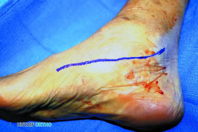 ISOLATED MEDIAL INCISION FOR TRIPLE ARTHRODESIS Surgical Diagram