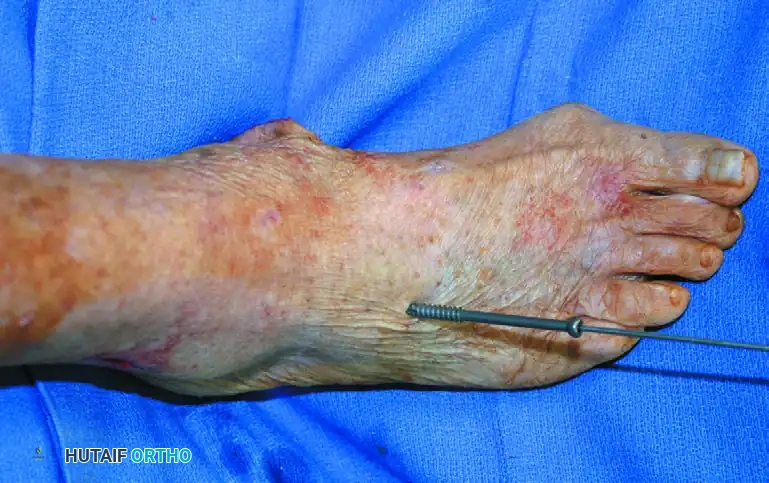 ISOLATED MEDIAL INCISION FOR TRIPLE ARTHRODESIS Surgical Diagram
