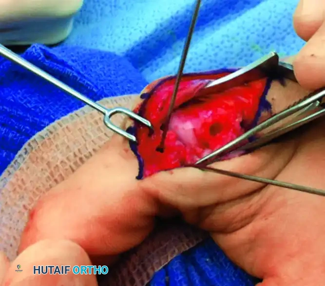 JOBE FOUR-LIMB RECONSTRUCTION Surgical Diagram
