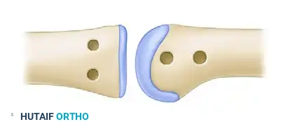 JOBE FOUR-LIMB RECONSTRUCTION Surgical Diagram