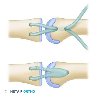 JOBE FOUR-LIMB RECONSTRUCTION Surgical Diagram