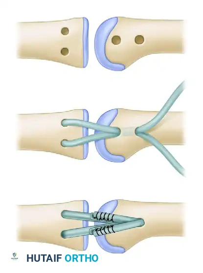 JOBE FOUR-LIMB RECONSTRUCTION Surgical Diagram