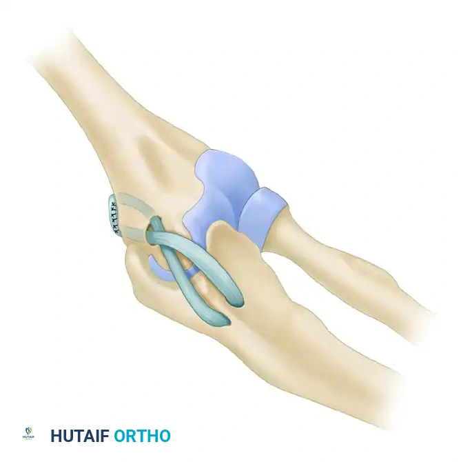FIGURE 47-53 Andrews technique of reconstruction of ulnar collateral ligament using tendon autograft. Drill hole locations and technique of suturing graft are shown. SEE TECHNIQUE 47-17 .