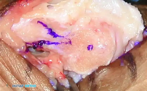 JOHNSON MODIFIED CHEVRON OSTEOTOMY Surgical Diagram
