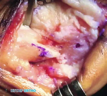 JOHNSON MODIFIED CHEVRON OSTEOTOMY Surgical Diagram