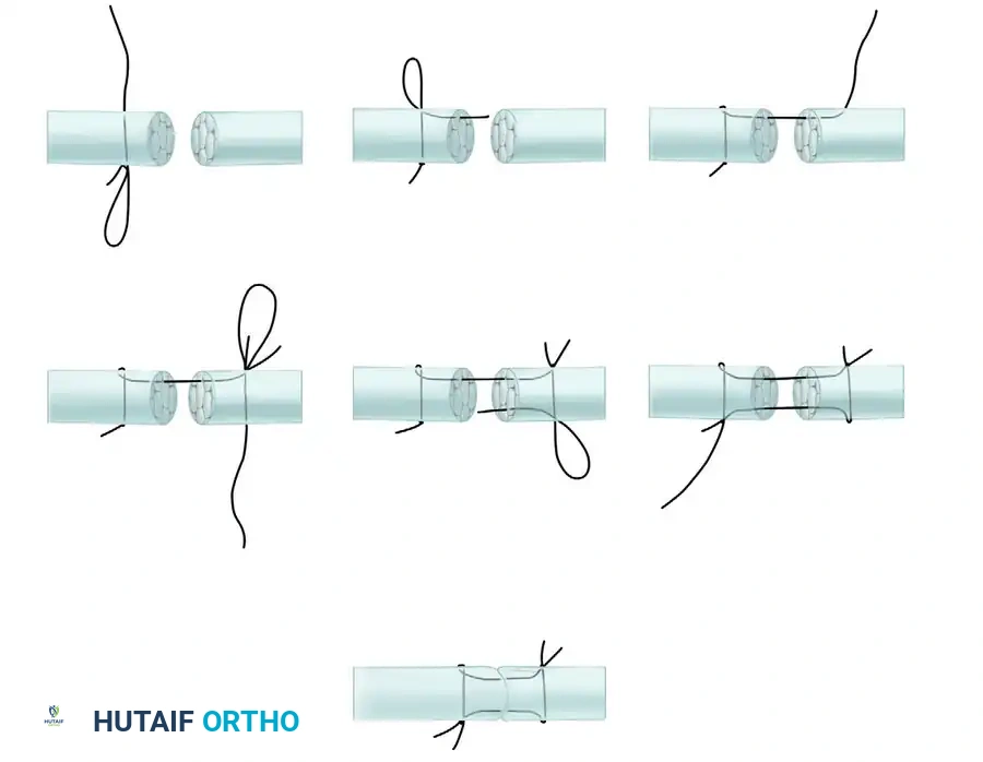 Masterclass in Tendon Repair: The Kessler and Tajima Techniques