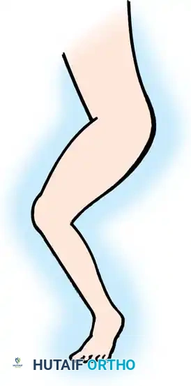 Knee Deformities in Cerebral Palsy: Evaluation & Surgery