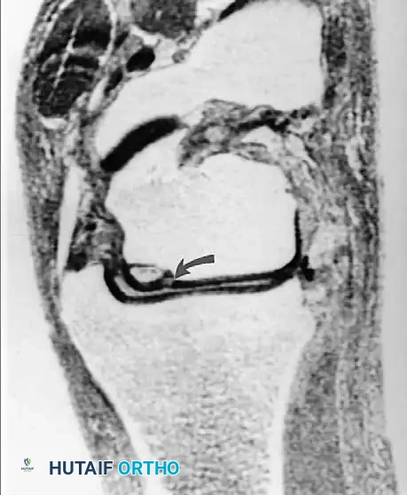 صورة توضح السوائل حول القطعة العظمية غير المستقرة