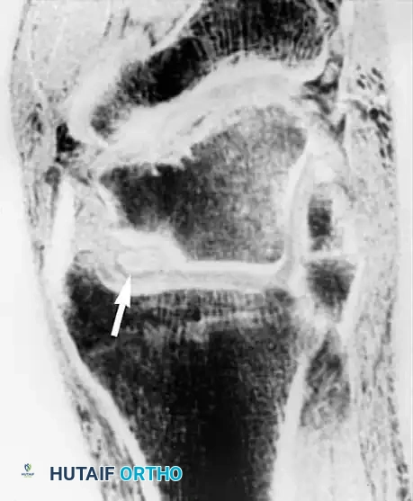 تأكيد وجود عيب غضروفي باستخدام تقنيات التصوير المتقدمة