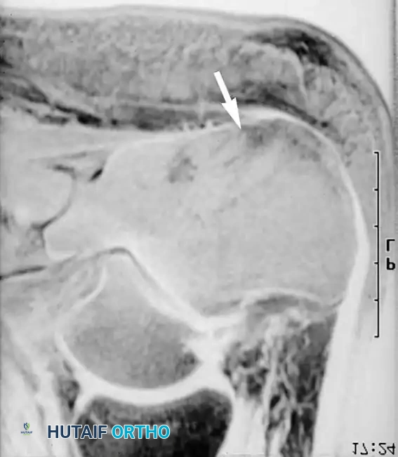 صورة رنين مغناطيسي لنفس المريض تظهر التهابا واضحا في نخاع العظم