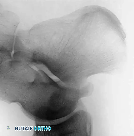 صورة أشعة سينية عادية لا تظهر أي تشوهات واضحة