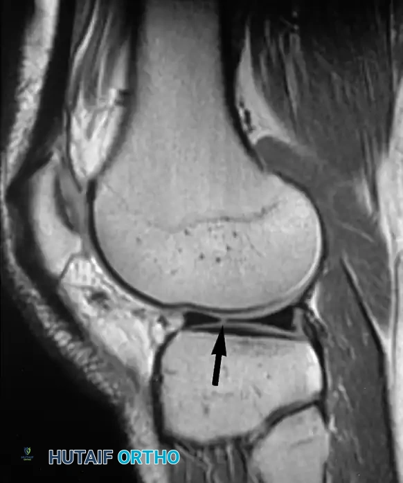 تمزق شعاعي صغير في الحافة الحرة للغضروف الهلالي الوحشي