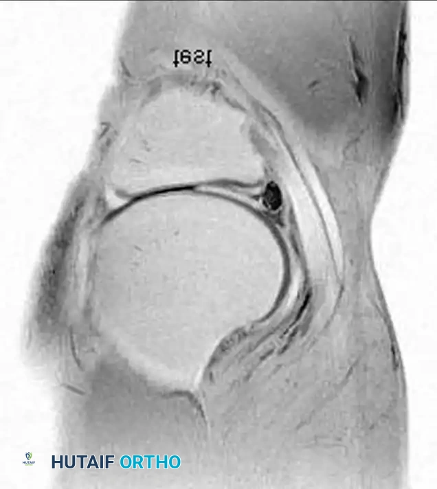 كيس غضروفي كبير مصاحب لتمزق في الغضروف الهلالي